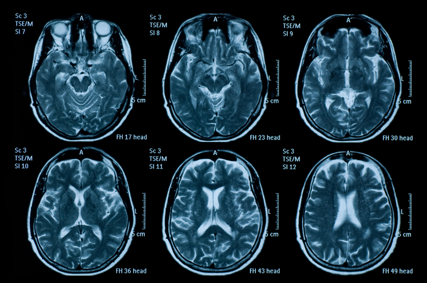 Archive: Brain Imaging Results Skewed by Biased Study Samples | UC